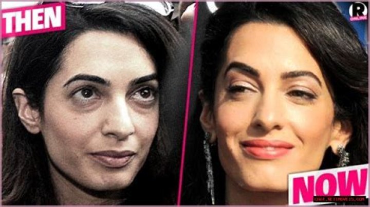 Amal Clooney's Journey: The Truth Behind Her Surgery Speculations
