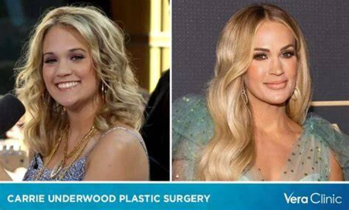 Carrie Underwood's Plastic Surgery Transformation Revealed