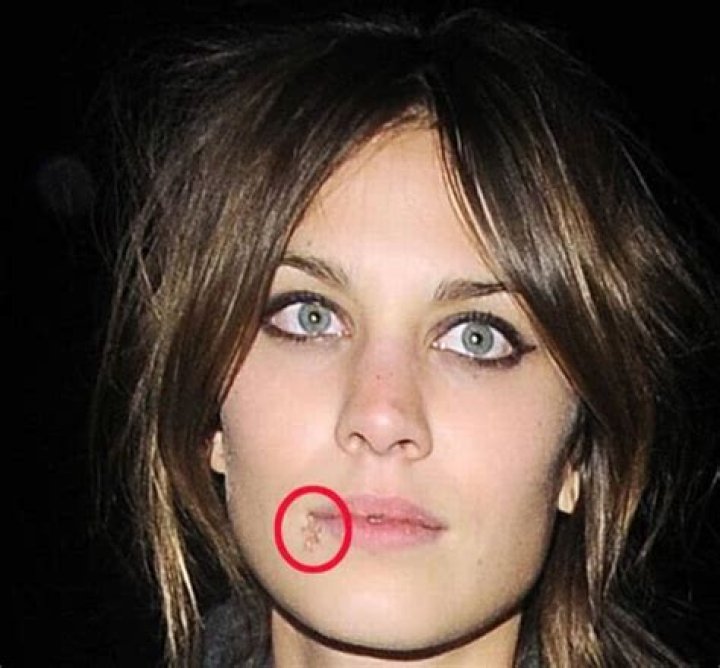 Celebrities with Cold Sores: Understanding the Stigma and Reality