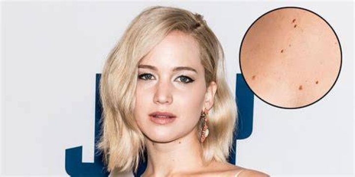 Celebrities with Moles: Embracing Natural Beauty and Individuality