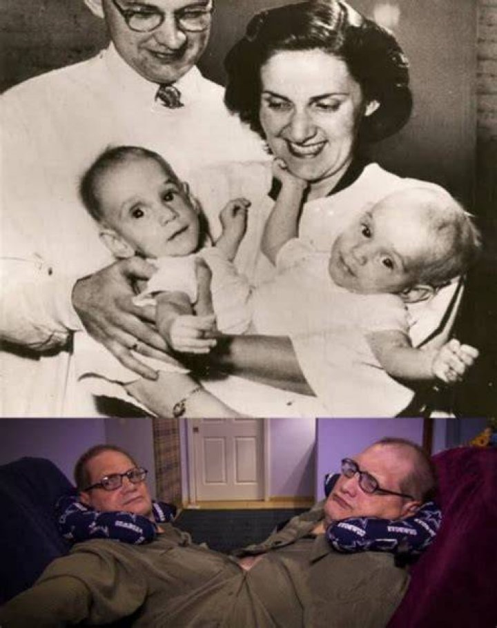 Conjoined Twins in Dayton Ohio: A Comprehensive Exploration of Their Lives and Impact