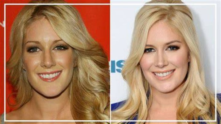 Heidi Montag's Transformation: Before and After Plastic Surgery