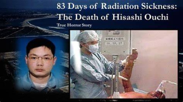 Hisashi Ouchi Real Body Photo: The Tragic Story Behind the Images