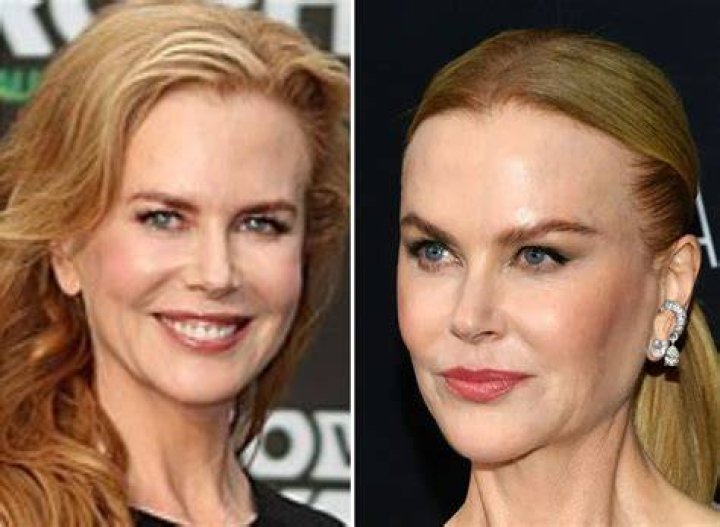 Nicole Kidman: The Evolution Through Plastic Surgery