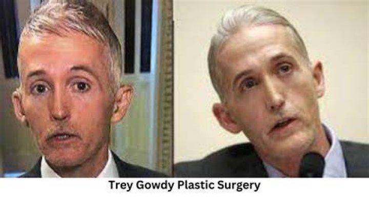 Unmasking the Truth: Has Trey Gowdy Had Plastic Surgery?